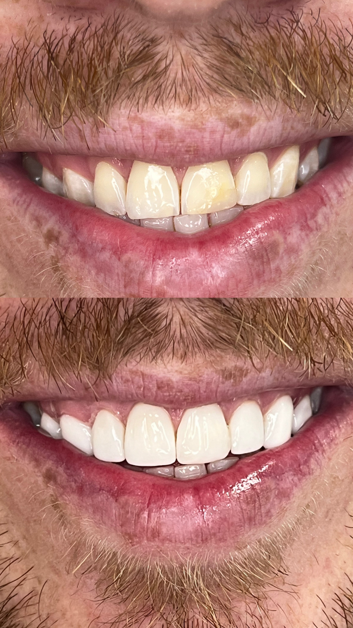 Resultado de tratamento: Lentes e facetas